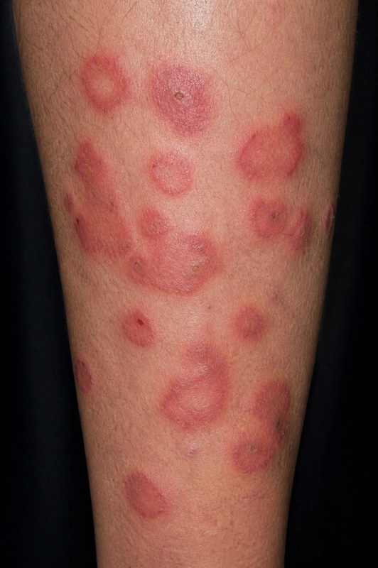 Wells-Syndrom (eosinophile Zellulitis): erysipelartige Plaques mit Eosinophilie (50-jährige(r) Patientin, Unterschenkel)