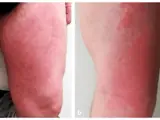 Wells-Syndrom (eosinophile Zellulitis)