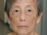 Werner-Syndrom (Progeria adultorum)