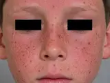 Xeroderma pigmentosum