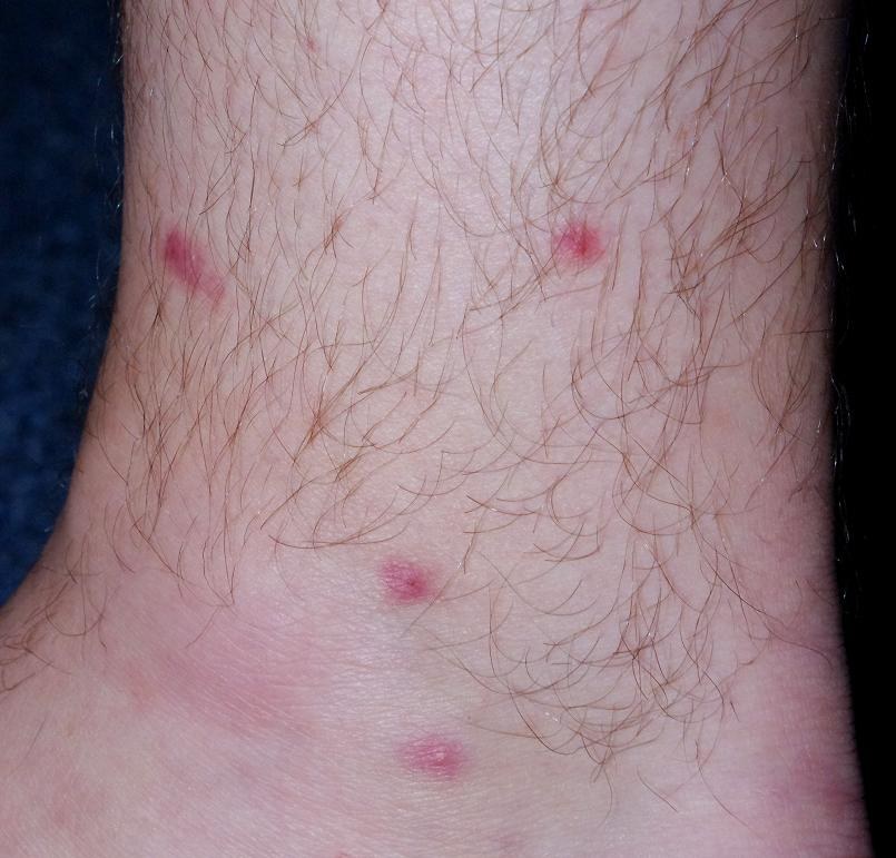 Zerkariendermatitis (Schistosomiasis-Larven, Badedermatitis): juckende, blutig-gestochene Papeln an Unterschenkel und Knöchel, 4 Tage nach Exposition